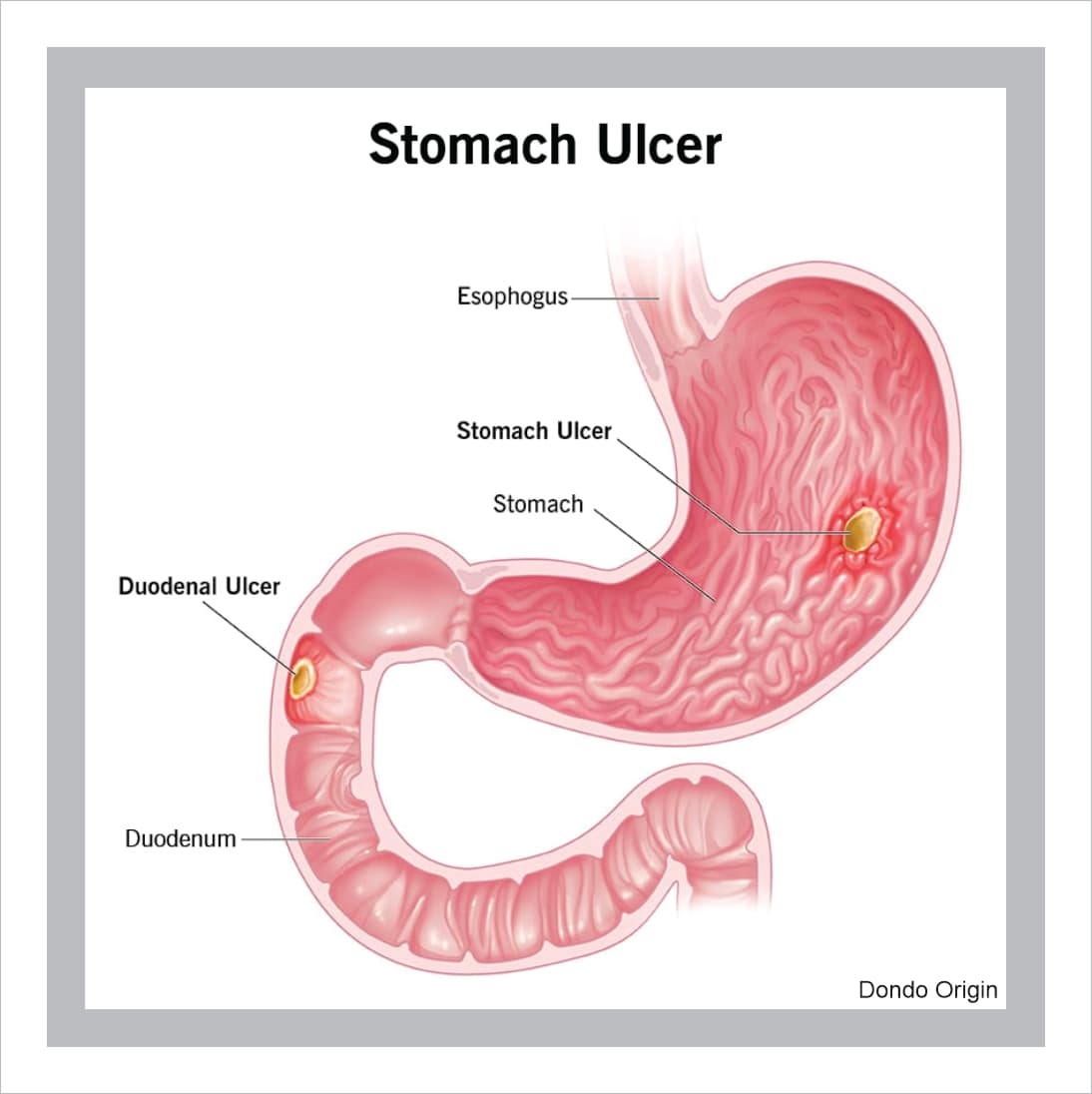 Ulcer Treatment Guide